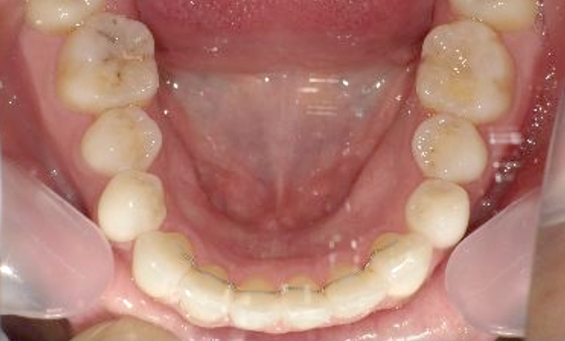 部分矯正 八重歯の症例写真