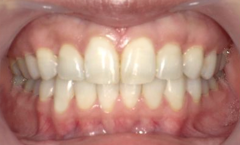 部分矯正 八重歯の症例写真