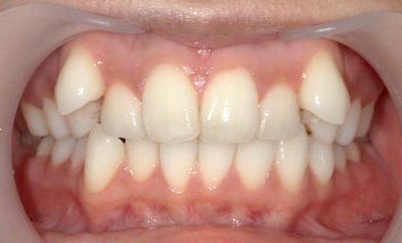 部分矯正 八重歯の症例写真