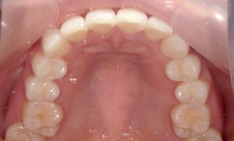 部分矯正 八重歯の症例写真