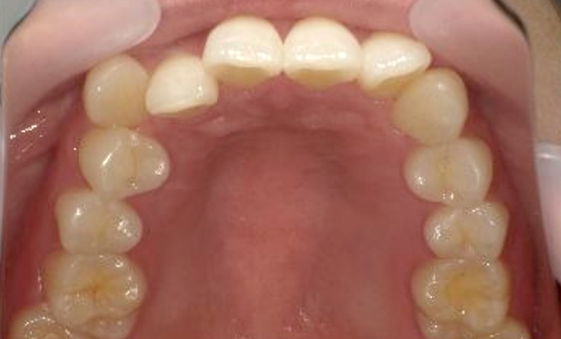 部分矯正 八重歯の症例写真