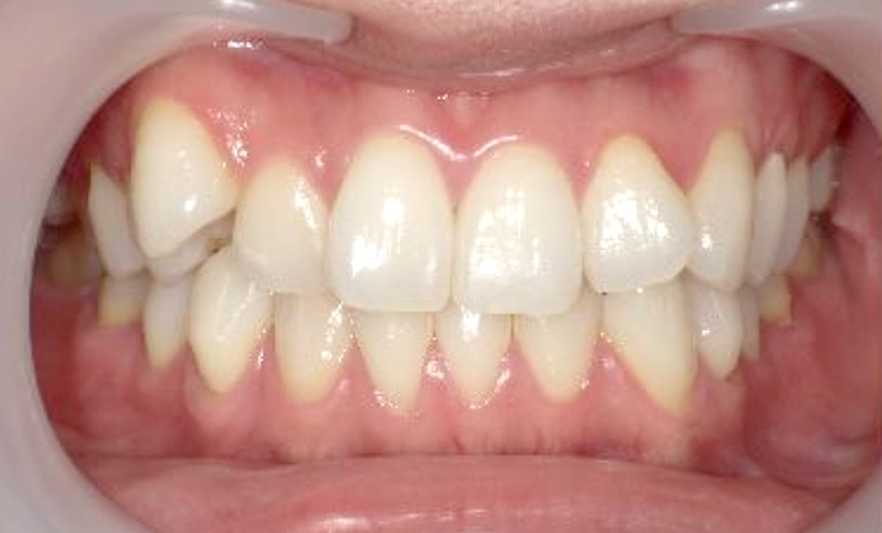 部分矯正 八重歯の症例写真