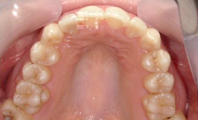 部分矯正 八重歯の症例写真