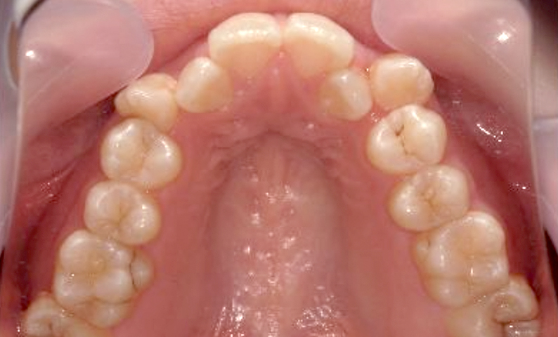 部分矯正 八重歯の症例写真