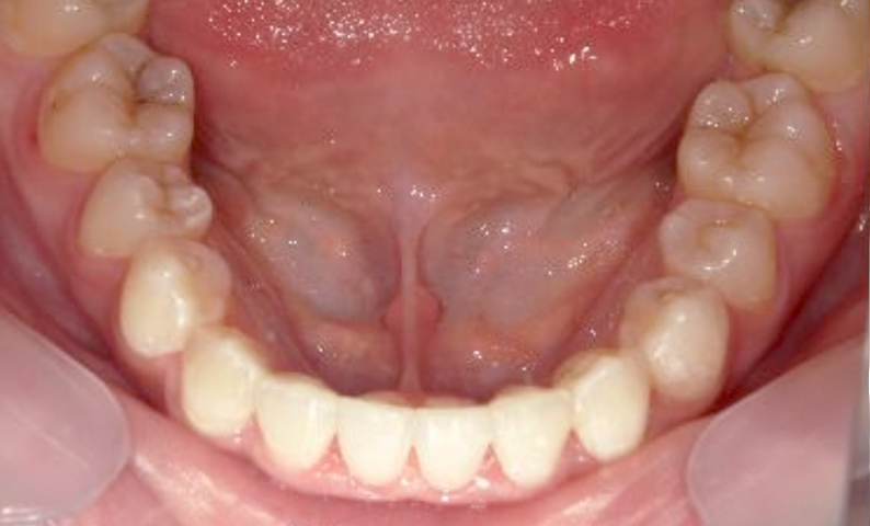 部分矯正 八重歯の症例写真