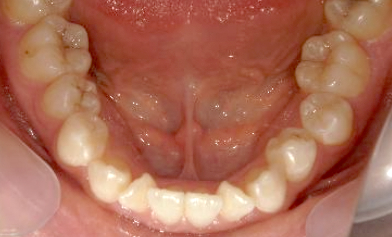 部分矯正 八重歯の症例写真