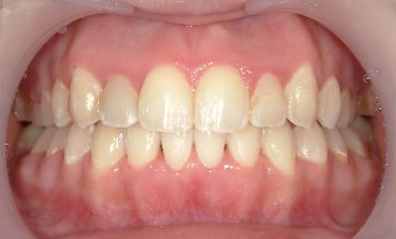 部分矯正 八重歯の症例写真