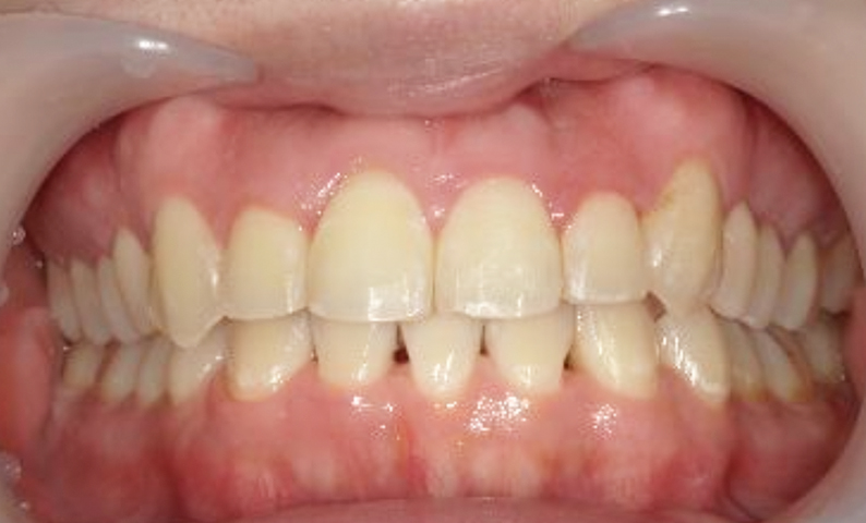 部分矯正 八重歯の症例写真