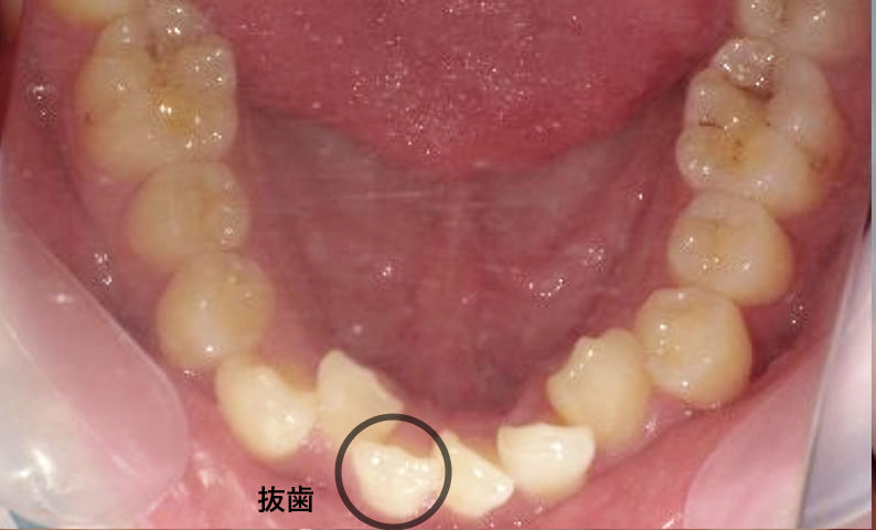 部分矯正 八重歯の症例写真