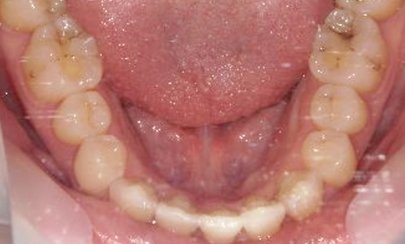 部分矯正 八重歯の症例写真