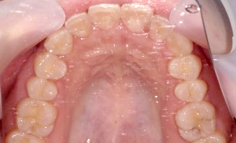 部分矯正 八重歯の症例写真