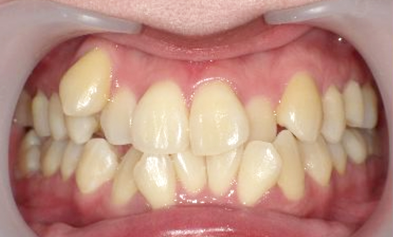 部分矯正 八重歯の症例写真