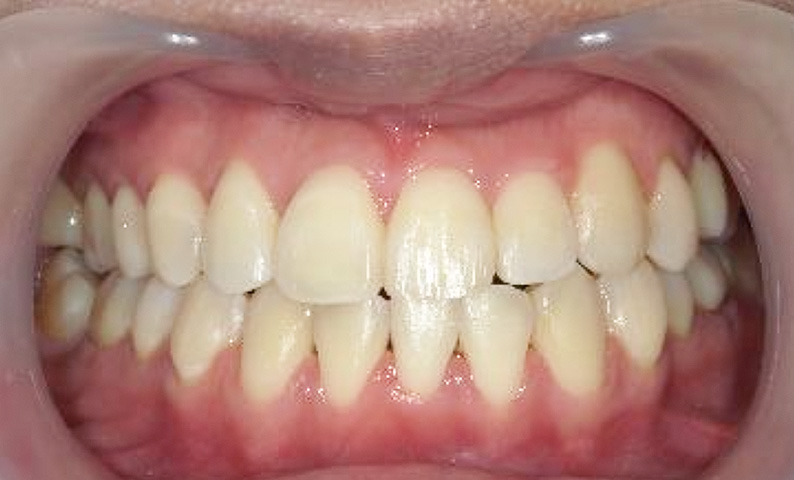 部分矯正 八重歯の症例写真