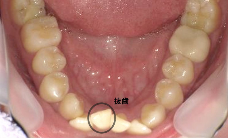 部分矯正 八重歯の症例写真
