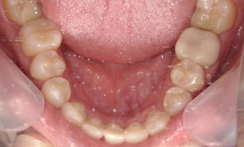 部分矯正 八重歯の症例写真