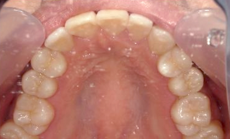 部分矯正 八重歯の症例写真