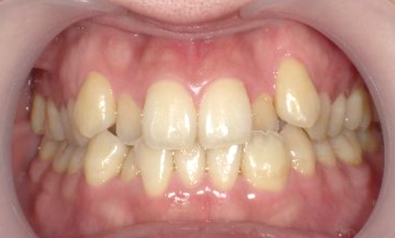 部分矯正 八重歯の症例写真