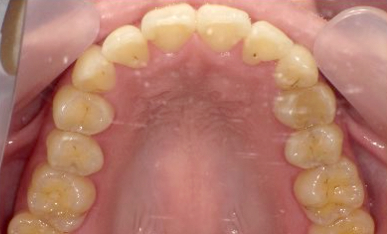 部分矯正 八重歯の症例写真