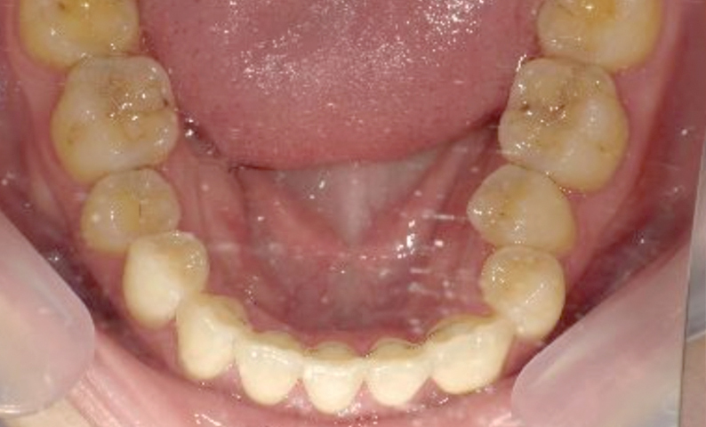 部分矯正 八重歯の症例写真