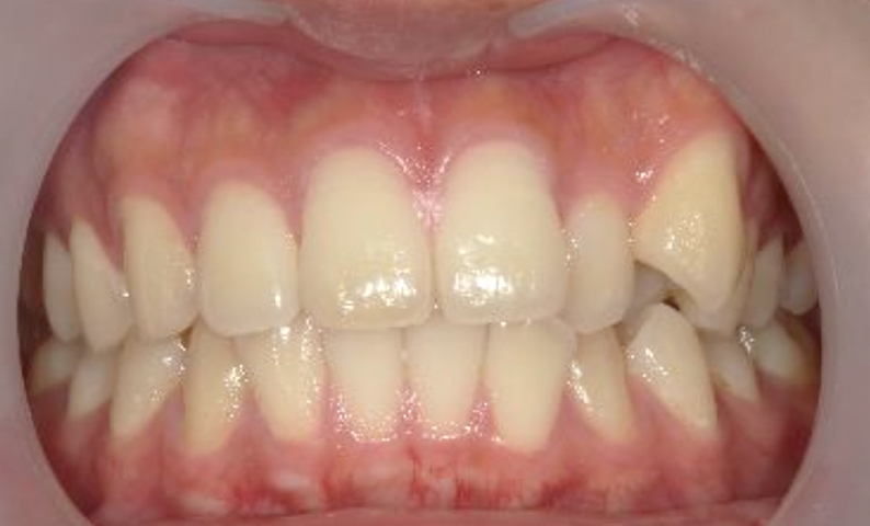 部分矯正 八重歯の症例写真