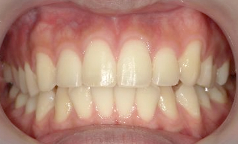 部分矯正 八重歯の症例写真