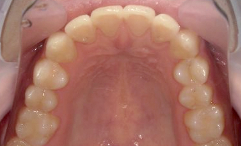 部分矯正 八重歯の症例写真