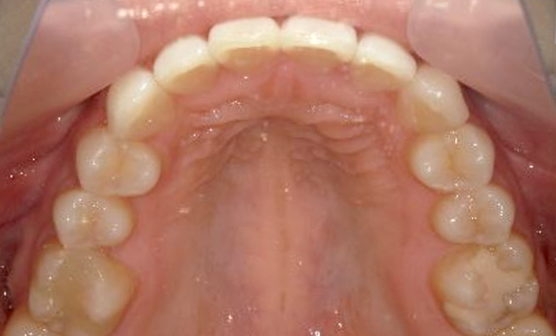 部分矯正 八重歯の症例写真