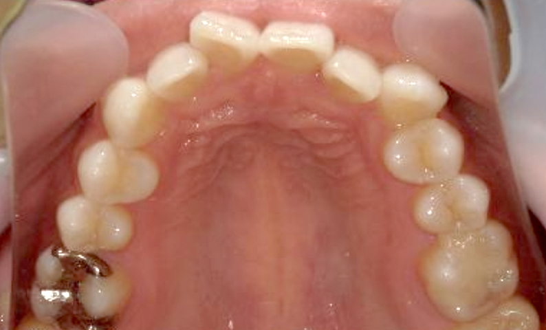 部分矯正 八重歯の症例写真