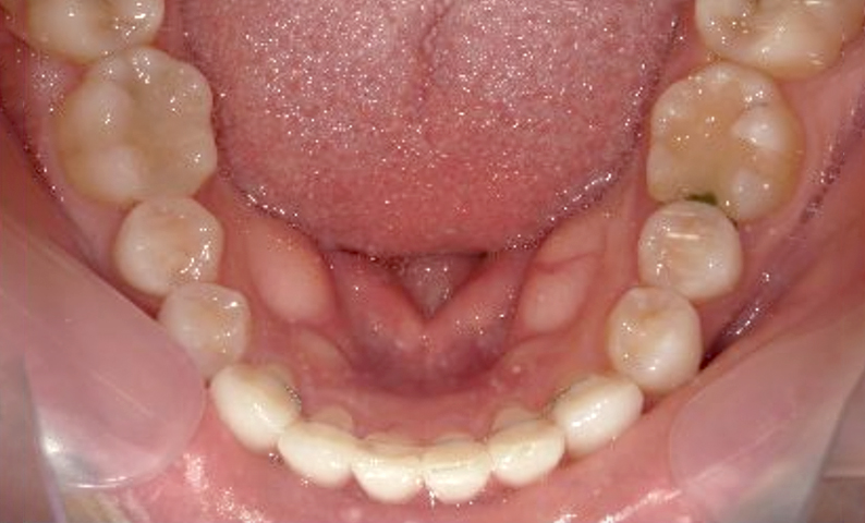 部分矯正 八重歯の症例写真