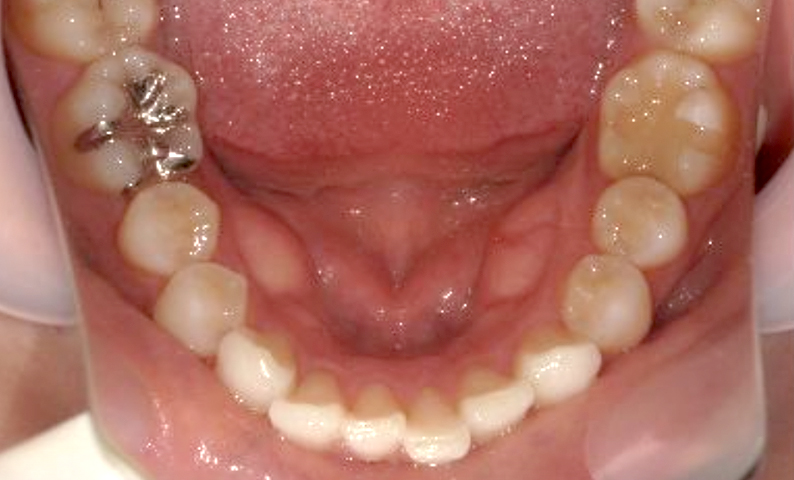 部分矯正 八重歯の症例写真