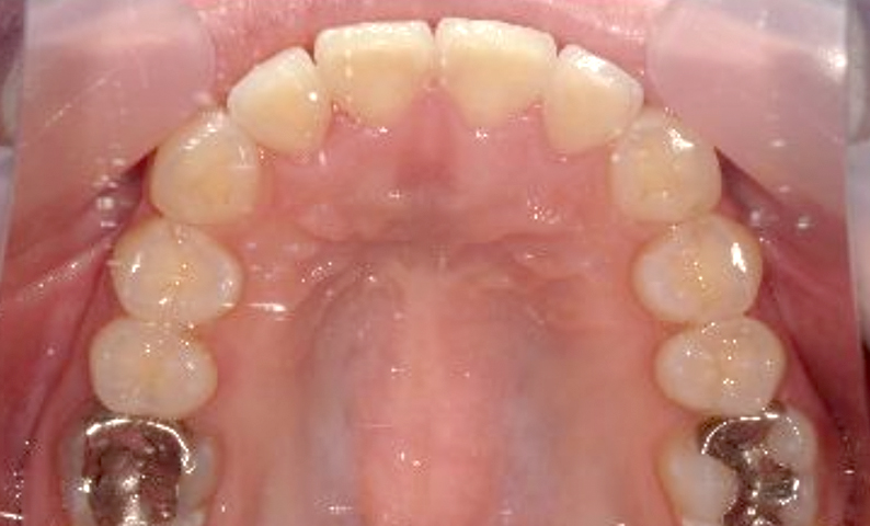 部分矯正 八重歯の症例写真