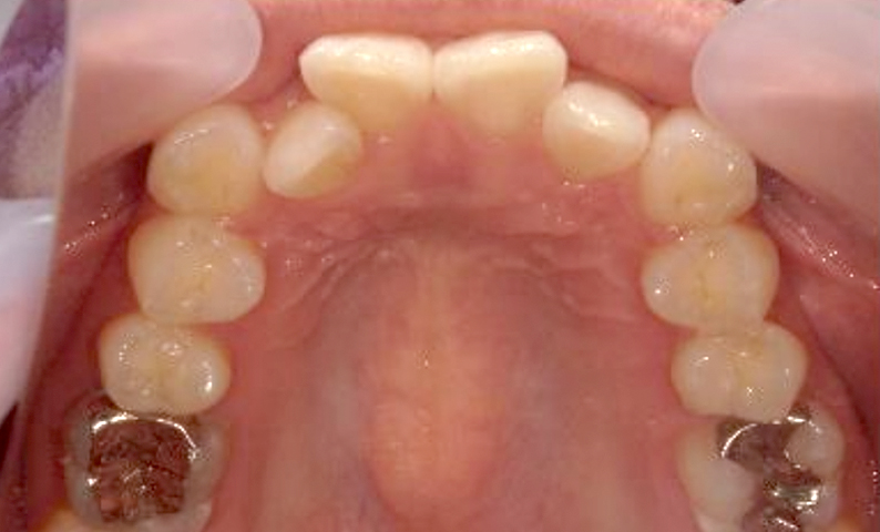 部分矯正 八重歯の症例写真