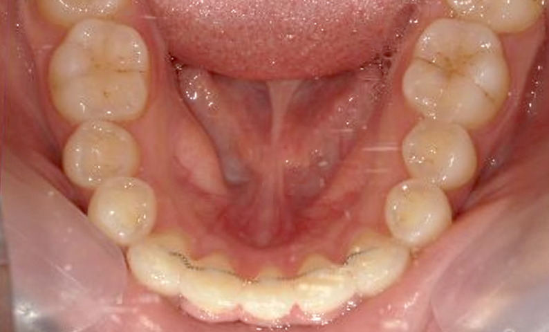 部分矯正 八重歯の症例写真