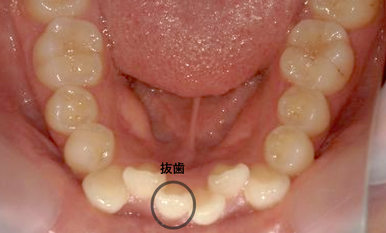 部分矯正 八重歯の症例写真