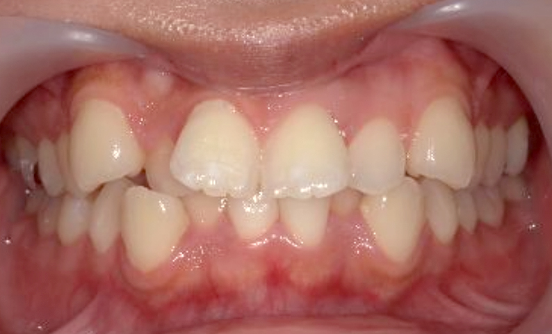 部分矯正 八重歯の症例写真