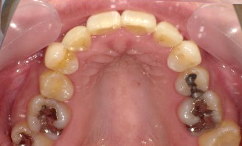 部分矯正 八重歯の症例写真