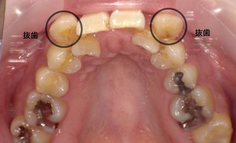 部分矯正 八重歯の症例写真