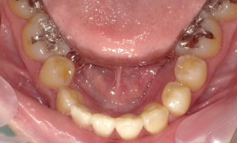 部分矯正 八重歯の症例写真