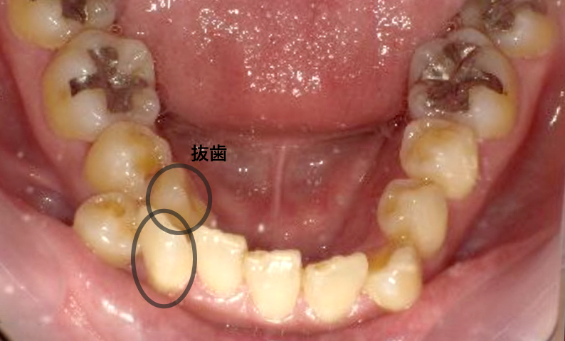 部分矯正 八重歯の症例写真