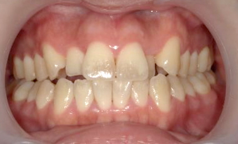 部分矯正 八重歯の症例写真