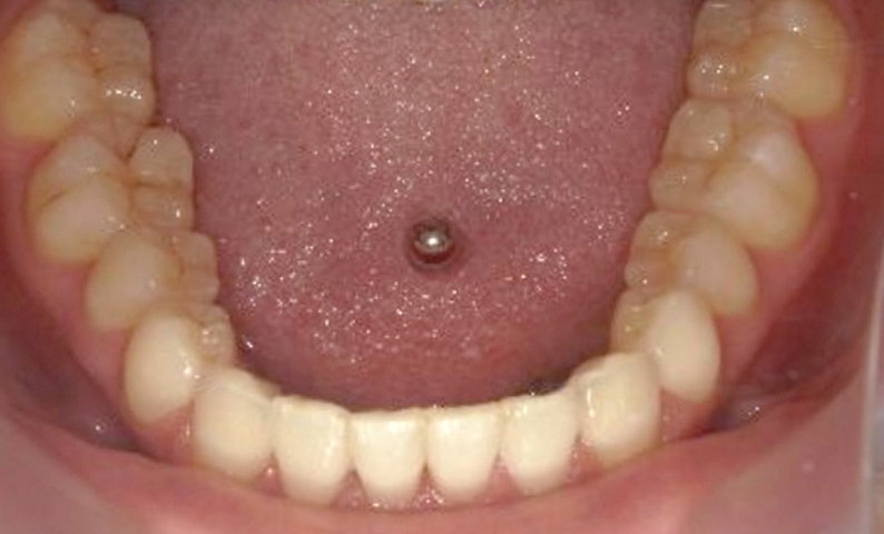 部分矯正 八重歯の症例写真