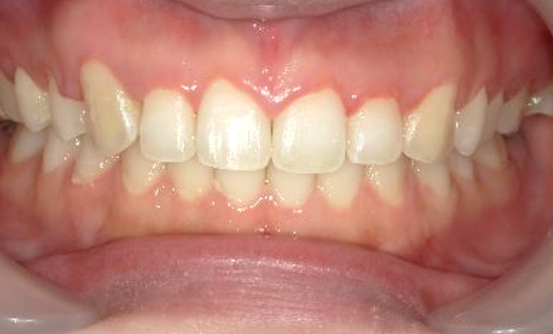 部分矯正 八重歯の症例写真