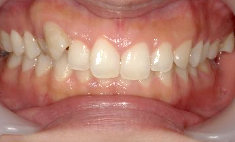 部分矯正 八重歯の症例写真