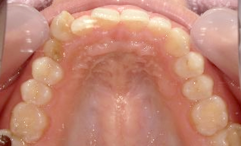 部分矯正 八重歯の症例写真