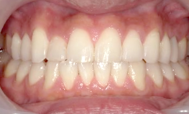 部分矯正 八重歯の症例写真