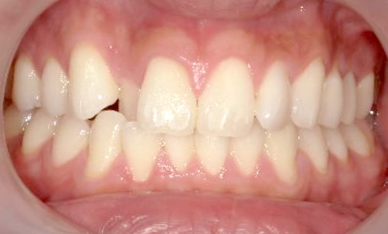 部分矯正 八重歯の症例写真