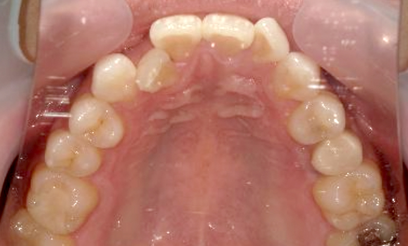 部分矯正 八重歯の症例写真