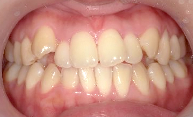 部分矯正 八重歯の症例写真