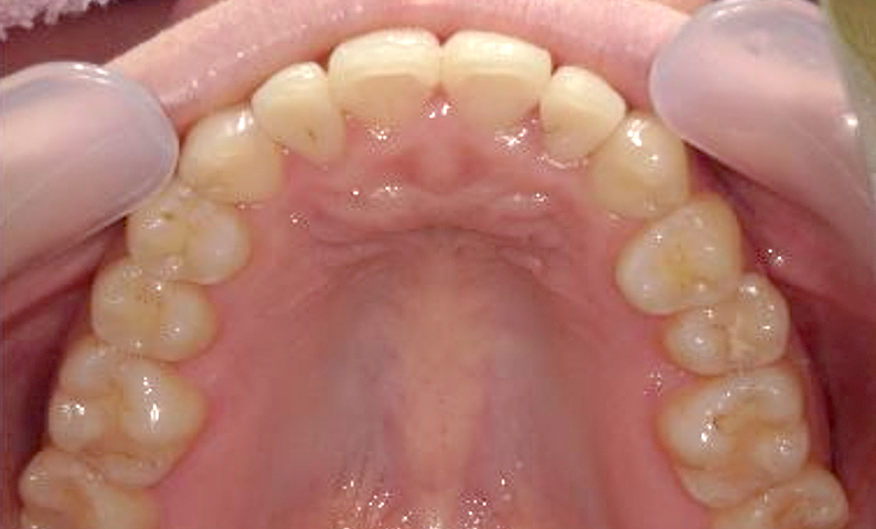 部分矯正 八重歯の症例写真