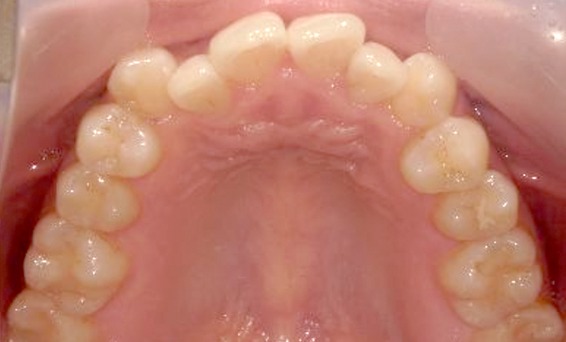 部分矯正 八重歯の症例写真